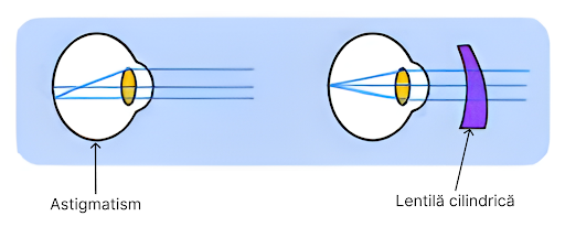 Diagrama corecție astigmatism