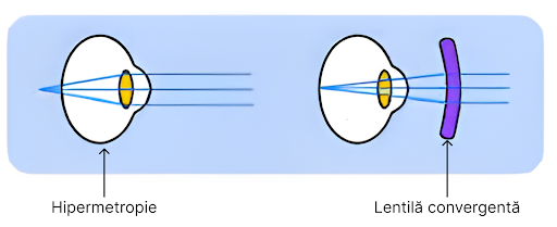 Diagrama corecție hipermetropie
