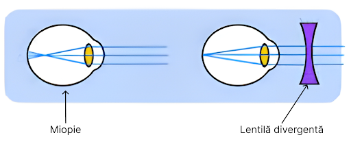 Diagrama corecție miopie